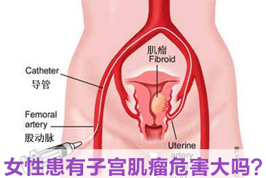 运城得了子宫肌瘤怎么办