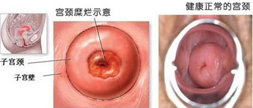 运城宫颈糜烂的原因