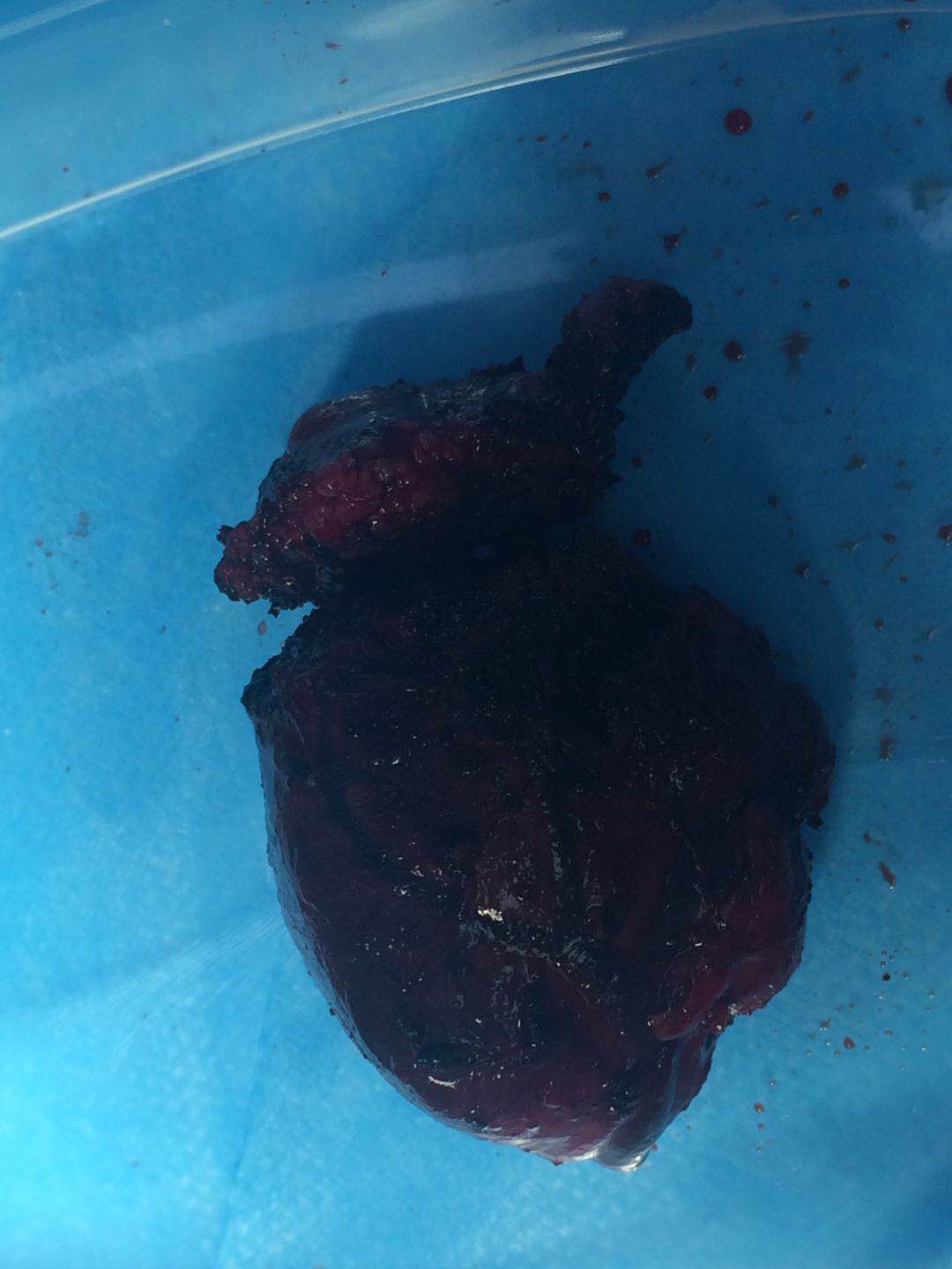 头条播报‖运城现代携手西安唐都赵华栋完成甲状腺手术顺利完成