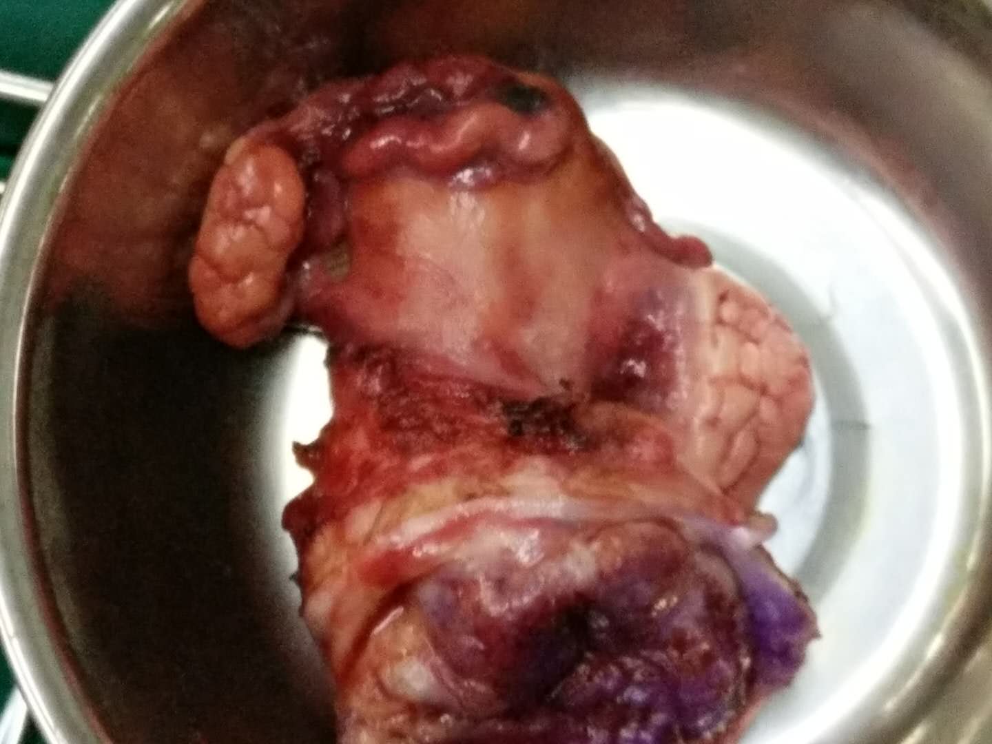 头条播报||运城现代宫颈癌患者成功被治愈